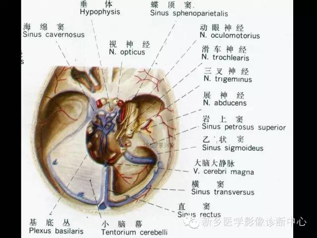 【病例学习】静脉窦血栓一例MR影像学表现
