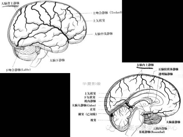 【病例学习】静脉窦血栓一例MR影像学表现