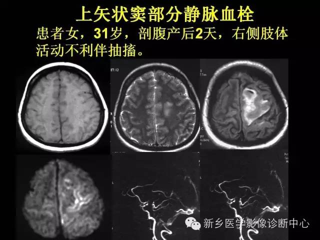 【病例学习】静脉窦血栓一例MR影像学表现