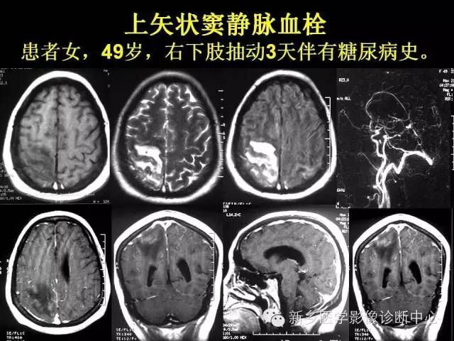 【病例学习】静脉窦血栓一例MR影像学表现