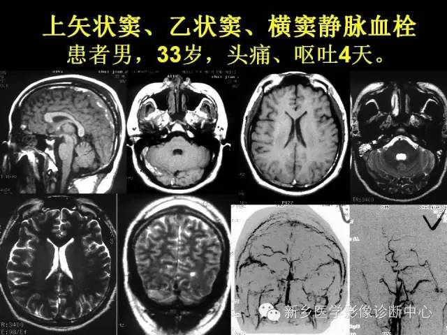 【病例学习】静脉窦血栓一例MR影像学表现