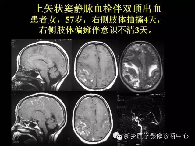 【病例学习】静脉窦血栓一例MR影像学表现