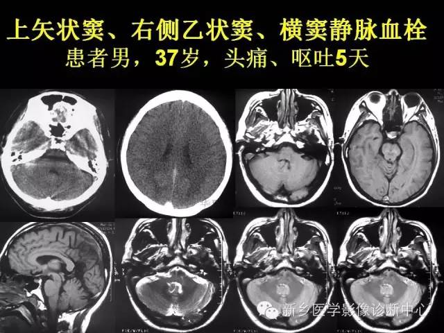 【病例学习】静脉窦血栓一例MR影像学表现