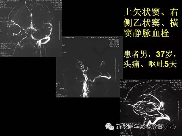 【病例学习】静脉窦血栓一例MR影像学表现