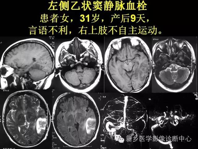 【病例学习】静脉窦血栓一例MR影像学表现