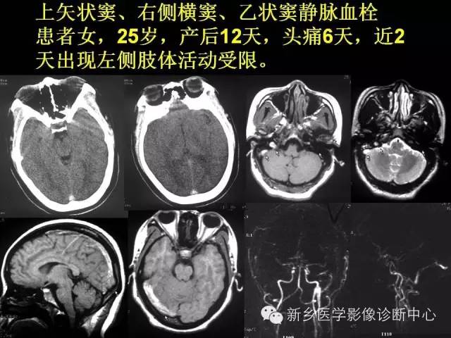 【病例学习】静脉窦血栓一例MR影像学表现