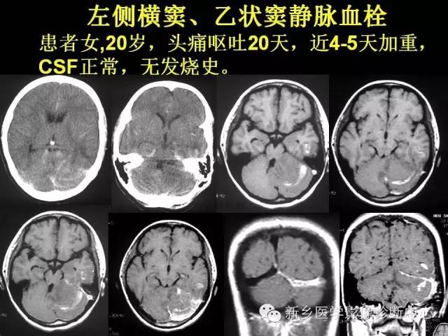 【病例学习】静脉窦血栓一例MR影像学表现