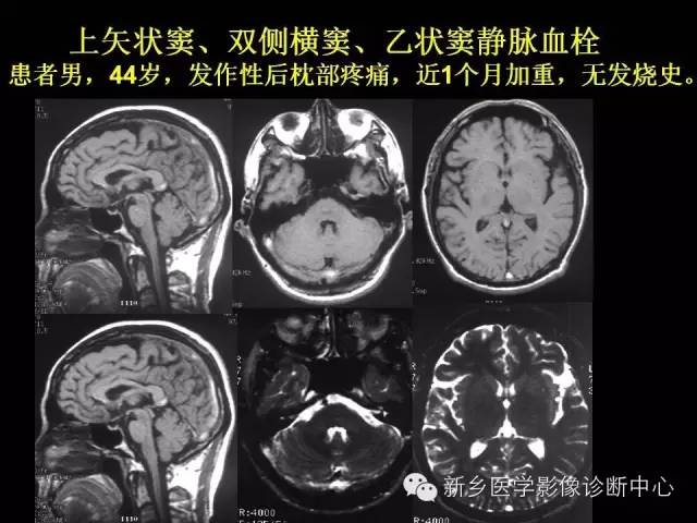 【病例学习】静脉窦血栓一例MR影像学表现