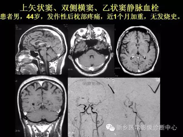 【病例学习】静脉窦血栓一例MR影像学表现