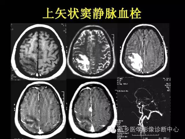 【病例学习】静脉窦血栓一例MR影像学表现