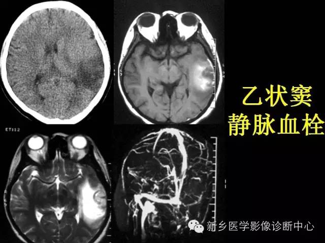 【病例学习】静脉窦血栓一例MR影像学表现