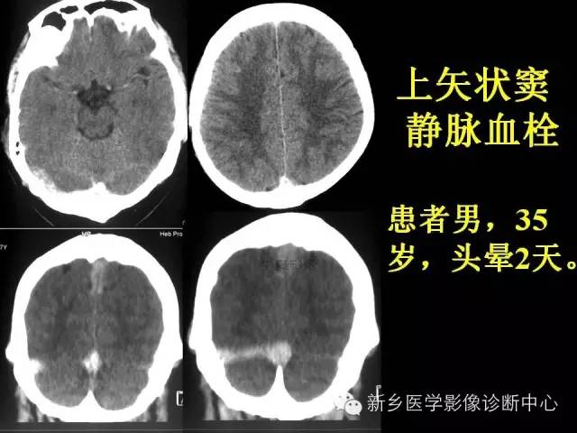 【病例学习】静脉窦血栓一例MR影像学表现