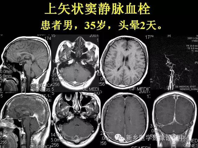 【病例学习】静脉窦血栓一例MR影像学表现