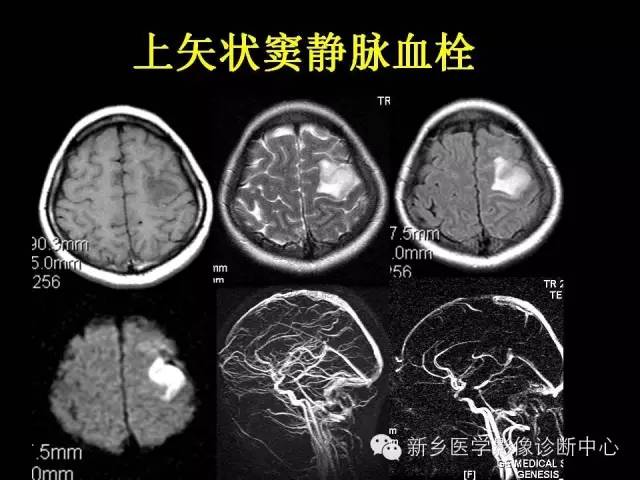【病例学习】静脉窦血栓一例MR影像学表现