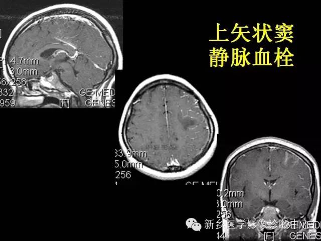 【病例学习】静脉窦血栓一例MR影像学表现