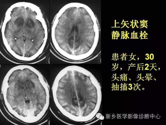 【病例学习】静脉窦血栓一例MR影像学表现