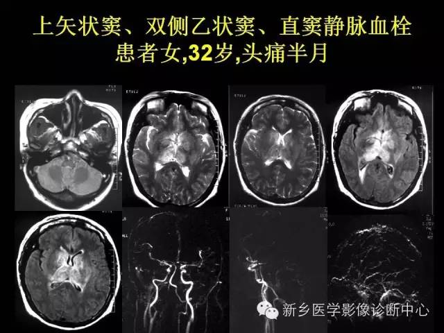 【病例学习】静脉窦血栓一例MR影像学表现