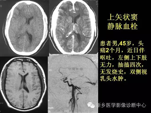 【病例学习】静脉窦血栓一例MR影像学表现