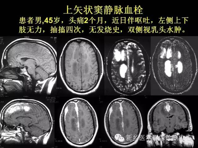 【病例学习】静脉窦血栓一例MR影像学表现
