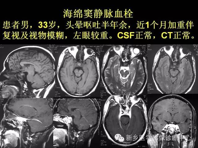 【病例学习】静脉窦血栓一例MR影像学表现