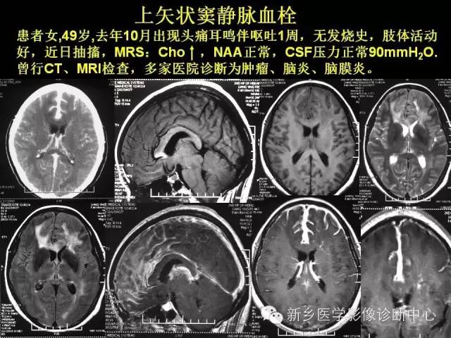 【病例学习】静脉窦血栓一例MR影像学表现