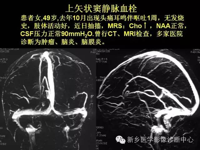 【病例学习】静脉窦血栓一例MR影像学表现