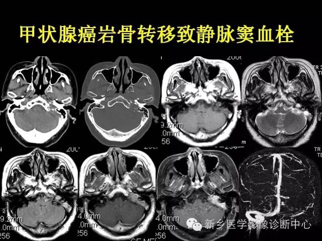 【病例学习】静脉窦血栓一例MR影像学表现