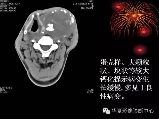 甲状腺肿瘤CT诊断分析及相关问题讨论