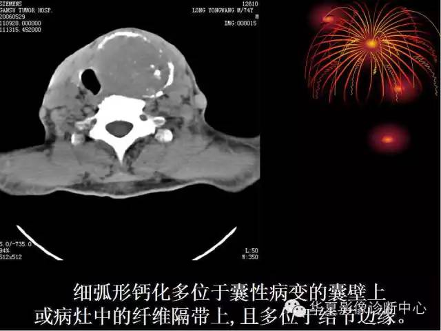 甲状腺肿瘤CT诊断分析及相关问题讨论