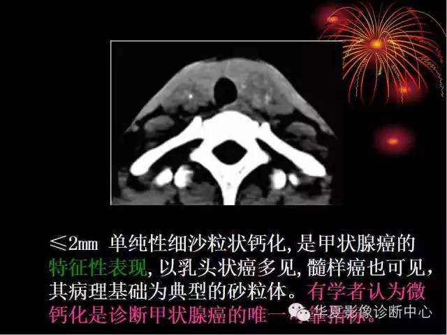 甲状腺肿瘤CT诊断分析及相关问题讨论
