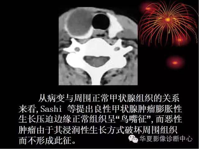 甲状腺肿瘤CT诊断分析及相关问题讨论