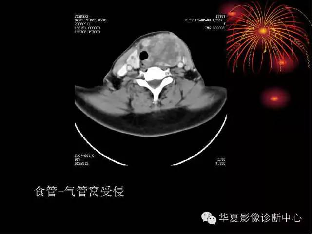 甲状腺肿瘤CT诊断分析及相关问题讨论