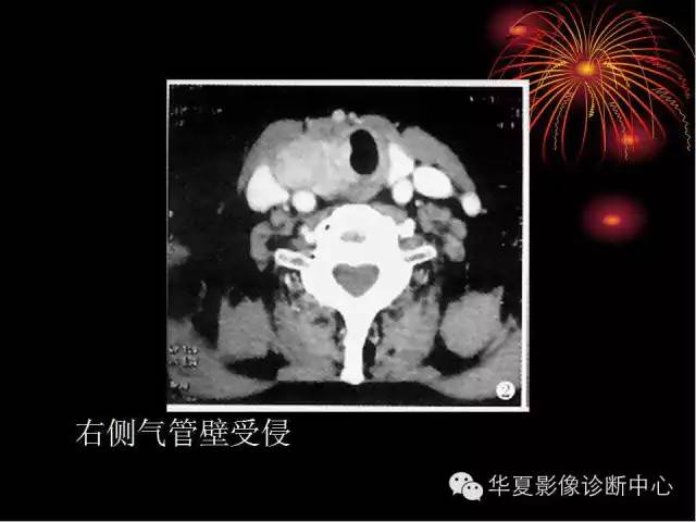 甲状腺肿瘤CT诊断分析及相关问题讨论
