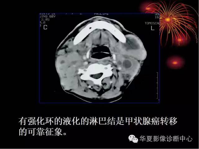 甲状腺肿瘤CT诊断分析及相关问题讨论