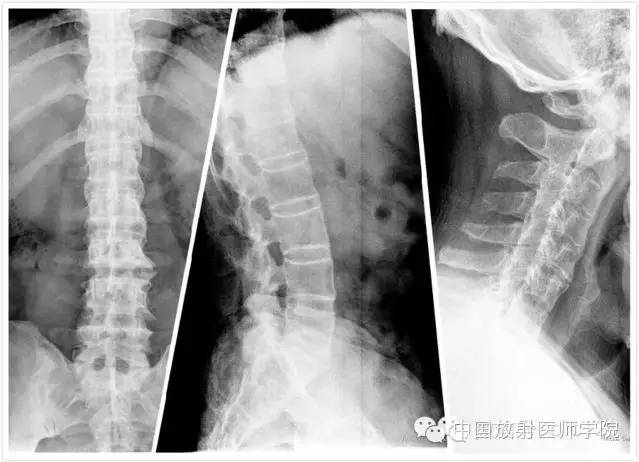 【病例学习】强直性脊柱炎一例X线影像表现