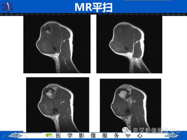 【病例学习】软组织内恶性孤立性纤维肉瘤一例