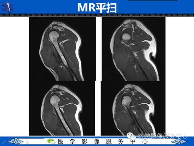 【病例学习】软组织内恶性孤立性纤维肉瘤一例