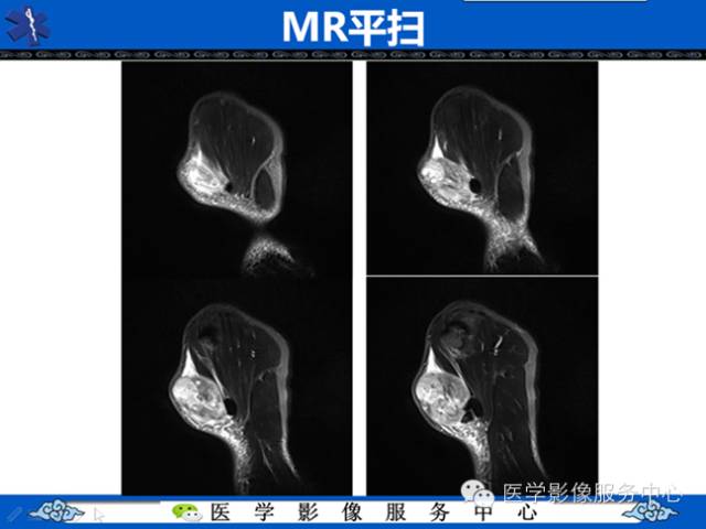 【病例学习】软组织内恶性孤立性纤维肉瘤一例