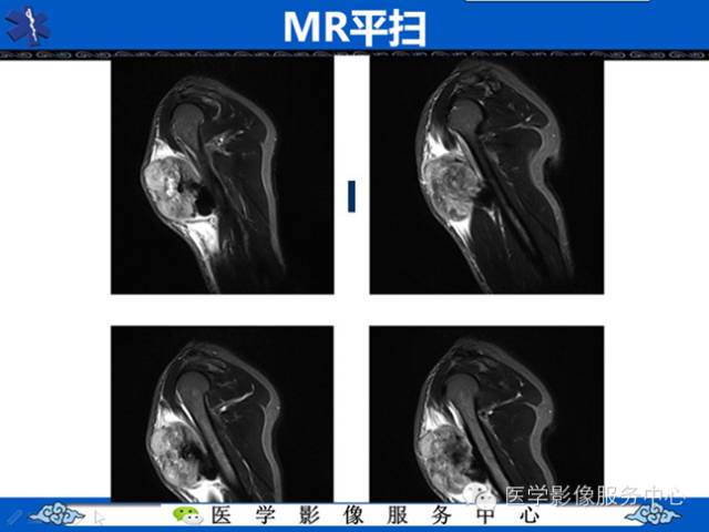 【病例学习】软组织内恶性孤立性纤维肉瘤一例