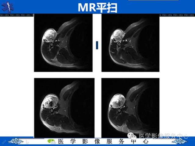 【病例学习】软组织内恶性孤立性纤维肉瘤一例