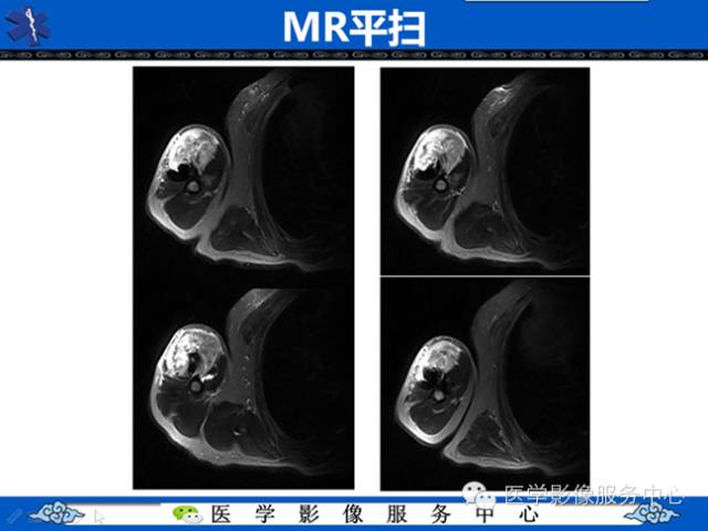 【病例学习】软组织内恶性孤立性纤维肉瘤一例