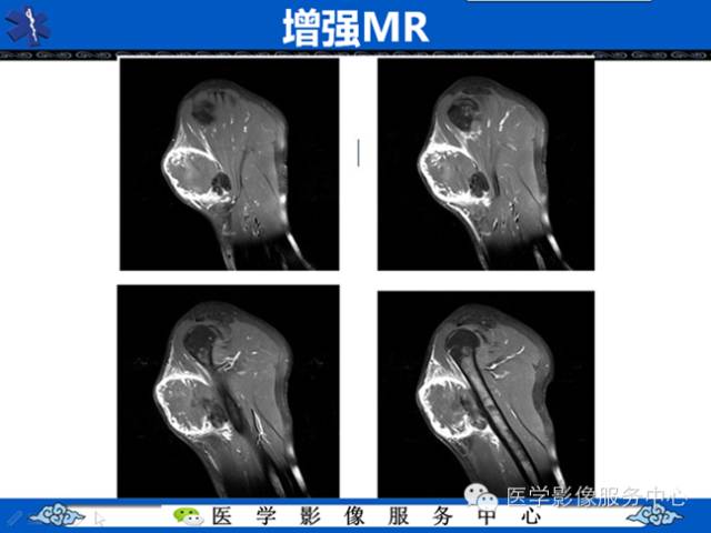 【病例学习】软组织内恶性孤立性纤维肉瘤一例