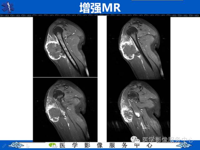 【病例学习】软组织内恶性孤立性纤维肉瘤一例