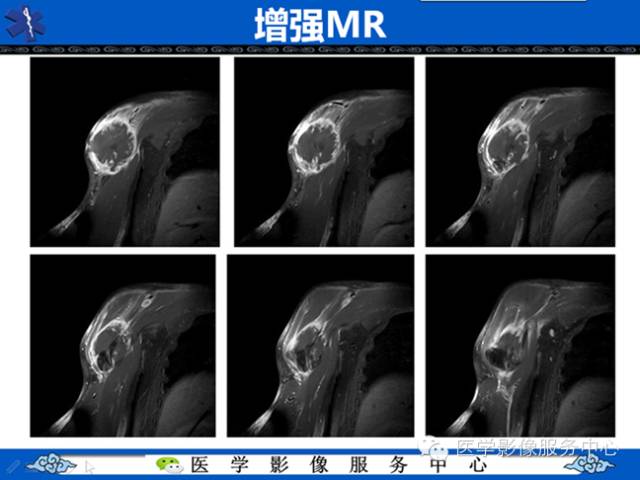 【病例学习】软组织内恶性孤立性纤维肉瘤一例
