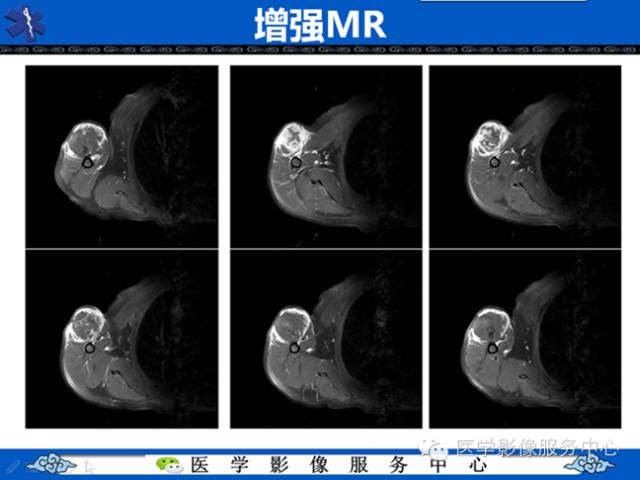 【病例学习】软组织内恶性孤立性纤维肉瘤一例