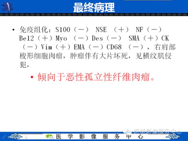 【病例学习】软组织内恶性孤立性纤维肉瘤一例