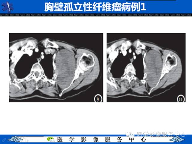 【病例学习】软组织内恶性孤立性纤维肉瘤一例