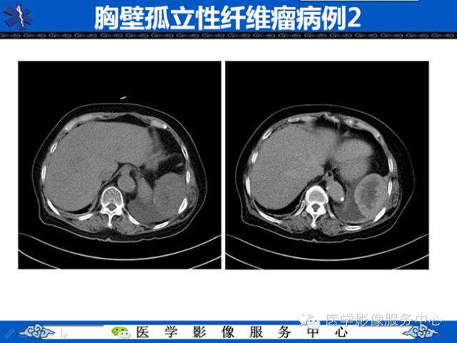 【病例学习】软组织内恶性孤立性纤维肉瘤一例