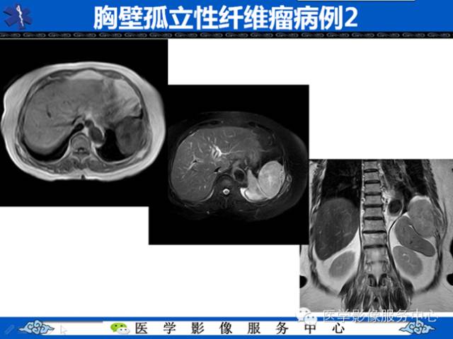 【病例学习】软组织内恶性孤立性纤维肉瘤一例