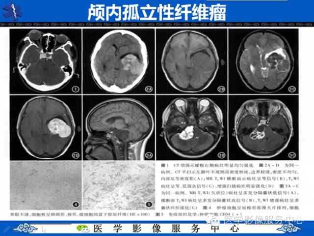 【病例学习】软组织内恶性孤立性纤维肉瘤一例